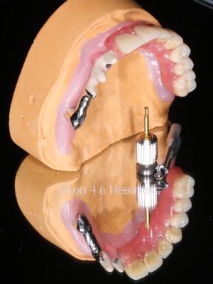 фото этапов операции all on 4 на верхней челюсти балка-гребенка на модели